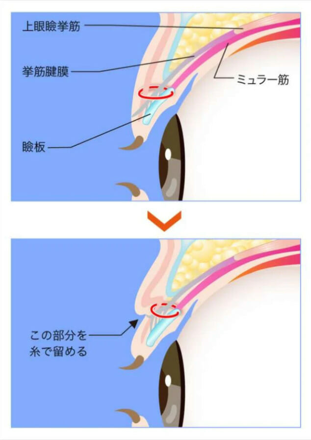 瞼板法施術方法。TCB東京中央美容外科より引用。