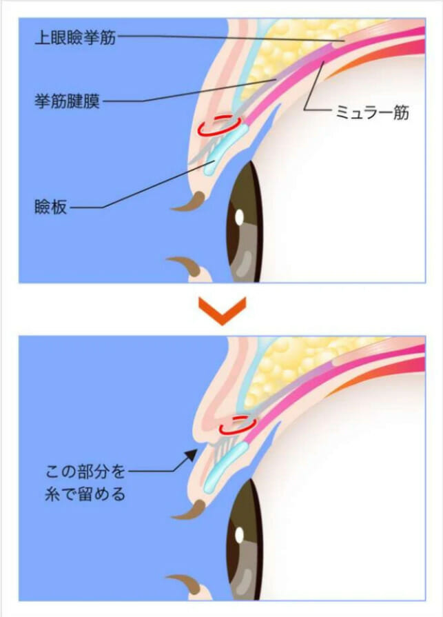 挙筋法施術方法。TCB東京中央美容外科より引用。